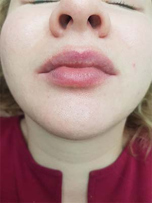 Фото губ до процедуры